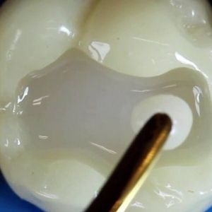 Londýnští vědci naučili zuby opravovat vlastní kazy